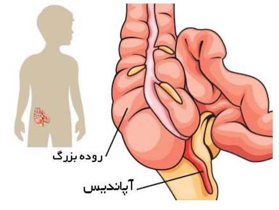 درمان آپاندیسیت، آپاندیس ،  التهاب آپاندیس ، عفونت آپاندیس،