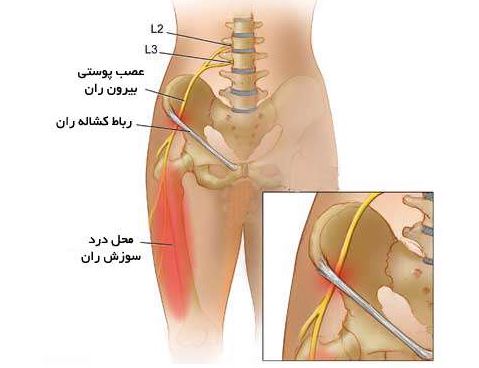  درد ران ، سوزش ران پا ،عصب بیرونی ران ، درد پا،