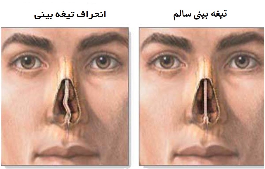 انحراف تیغه وسط بینی ، تیغه بینی سالم،