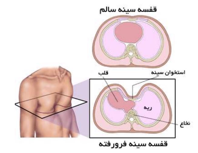 استخوان قفسه سینه ، قفسه سینه فرورفته،  قفسه سینه قیفی شکل، 