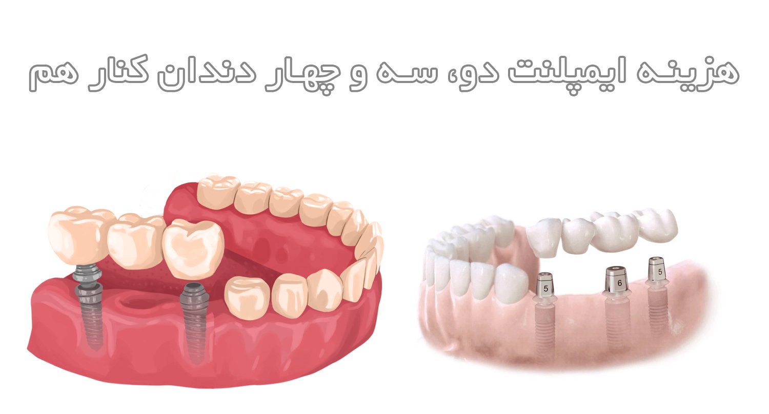 هزینه ایمپلنت دو، سه و چهار دندان کنار هم