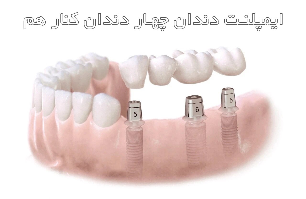 ایمپلنت دندان چهار دندان کنار هم