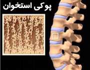 درمان پوكی استخوان