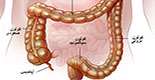 درمان کوليت روده