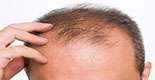 درمان آلوپسی مردانه (طاسی جلوی سر)