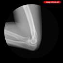 حرکت استخوان آرنج زیر اشعه ایکس