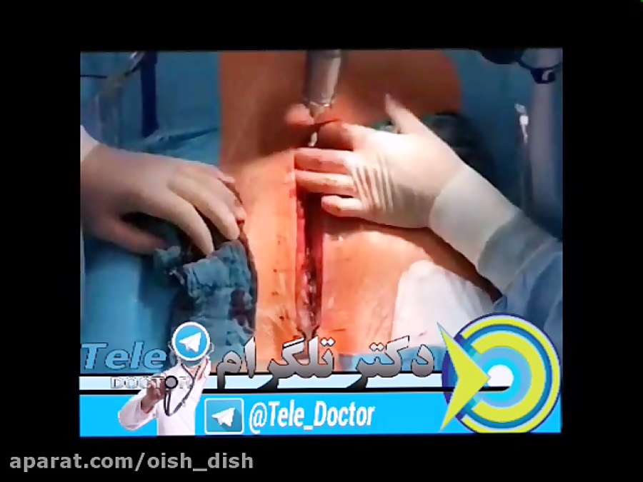 عمل جراحی قلب باز -بریدن قفسه برای رسیدن به قلب