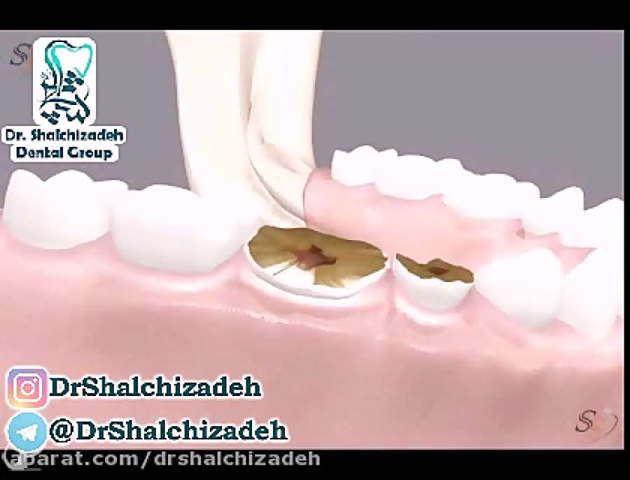 انیمیشن پیوند استخوان دندان 1