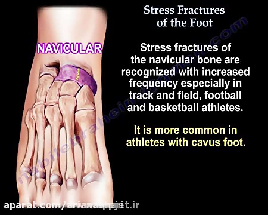 استرس شکستگی پا