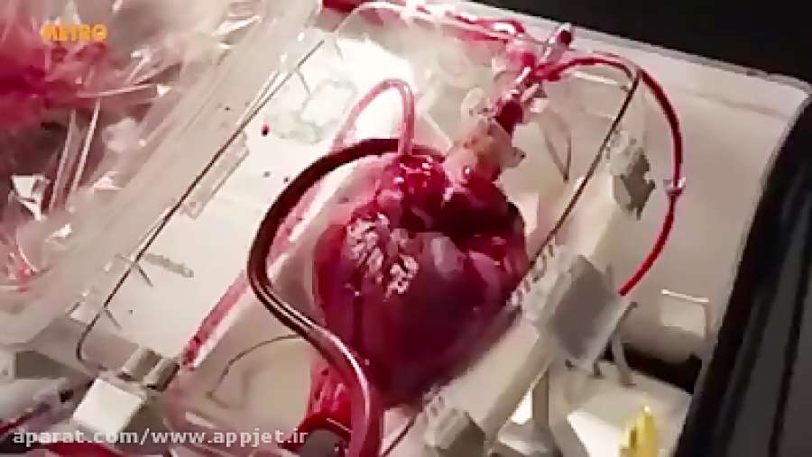 قلب را بیرون از بدن بیمار نگه داشته اند تا بعدا گذاشته