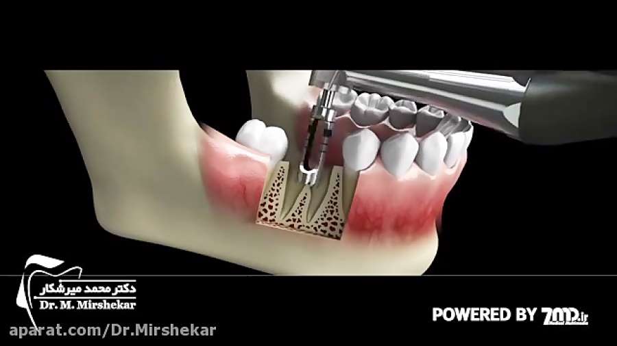 ایمپلنت فوری