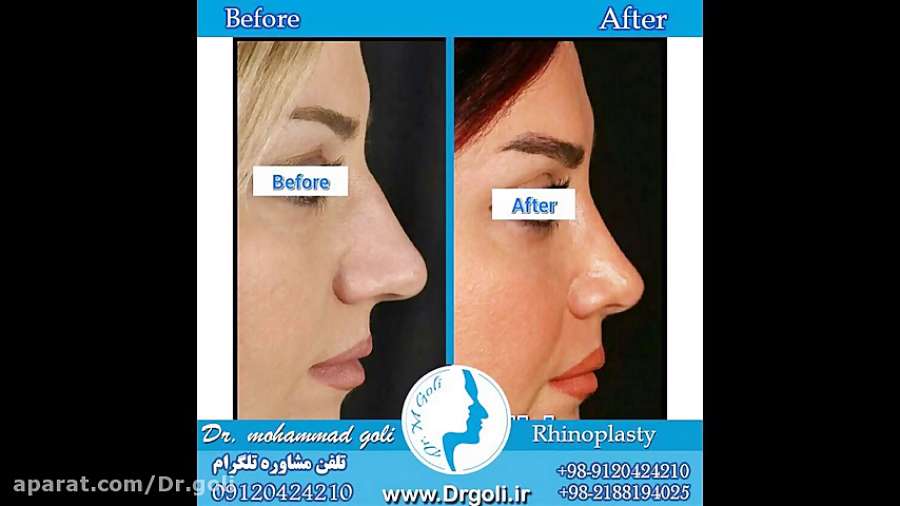 نمونه کار های جراحی بینی دکتر گلی سری 1