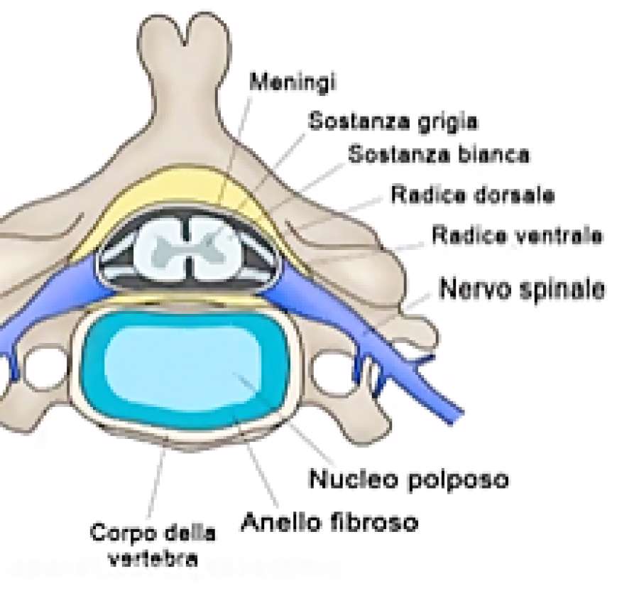 آسیب دیسک کمر