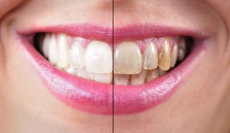 Limpieza dental.