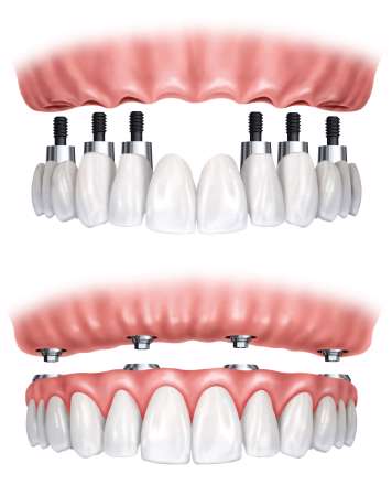 dental prostheses