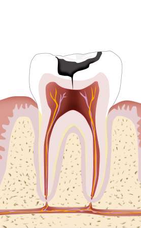 Zahn mit Karies, Endodontie 1