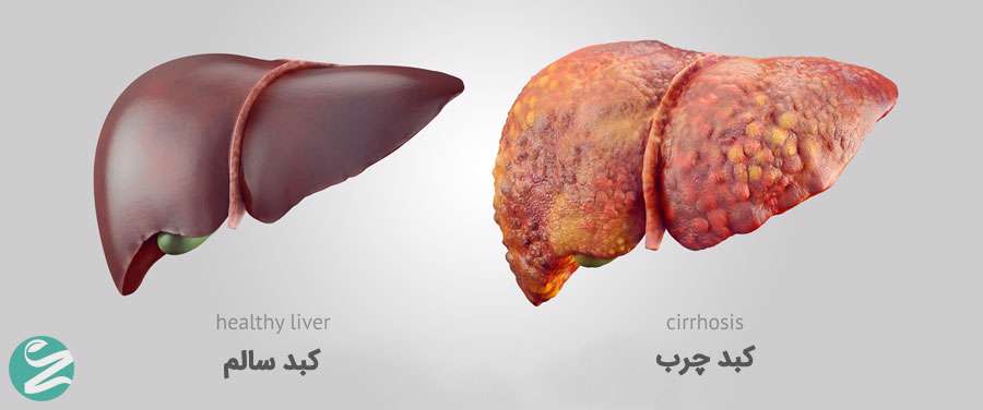 با این دو خوراکی جادویی کبد چرب خود را پاکسازی کنید!