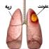 بیماری آبسه ریه بیماری آبسه ریه