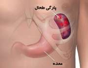 پارگی طحال