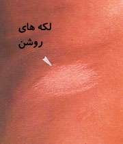 جذام