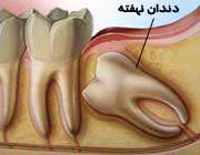 دندان نهفته