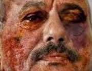 صالح کا جلا ہوا چہرہ پلاسٹک سرجری سے قبل 