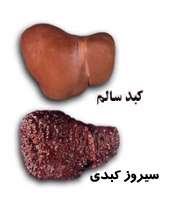 سیروز کبدی