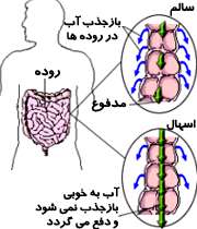 بیماری اسهال