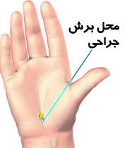 درمان سندرم تول کارپال با جراحی