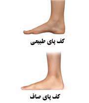 نابهنجاری های اندام تحتانی