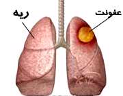 آبسه ریه