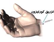 درمان سندرم تول کارپال با دارو