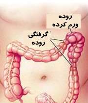 گرفتگی روده