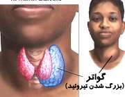 گواتر