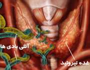 حمله آنتی بادی ها به غده تیروئید
