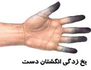 یخ زدگی انگشتان دست در سرمای شدید