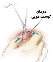 کیست مویی در پایین کمر