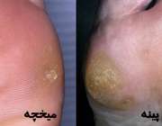 میخچه و پینه پا