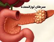 سرطان لوزالمعده
