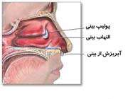 گرفتگی بینی