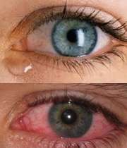 قرمزی چشم و اشک ریزش آن