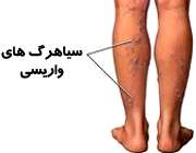 واریس پا