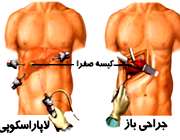 لاپاراسکوپی و جراحی باز کیسه صفرا