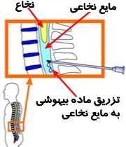 بی حسی نخاعی برای عمل جراحی