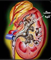 سنگ کلیه