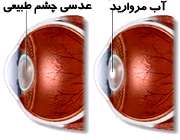 کدر شدن عدسی چشم در آب مروارید