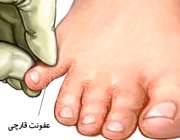 عفونت قارچی انگشتان پا