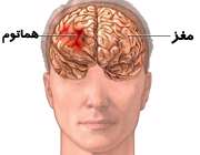 خونمردگی و کبودی پوست یا هماتوم مغزی