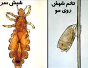 شپش موی سر