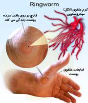 کرم حلقوی یا عفونت قارچی پوست به شکل حلقوی